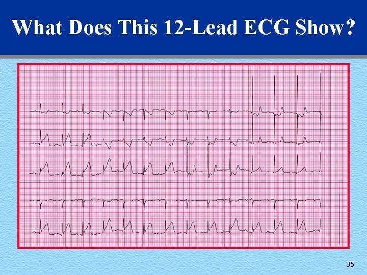 What Does This 12 -Lead ECG Show? 35 