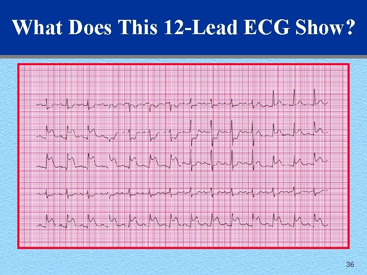 What Does This 12 -Lead ECG Show? 36 