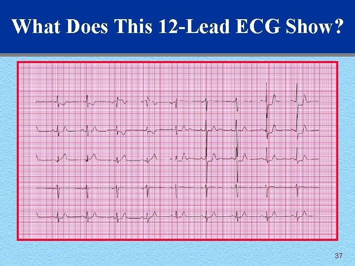 What Does This 12 -Lead ECG Show? 37 