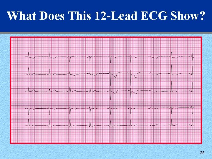 What Does This 12 -Lead ECG Show? 38 