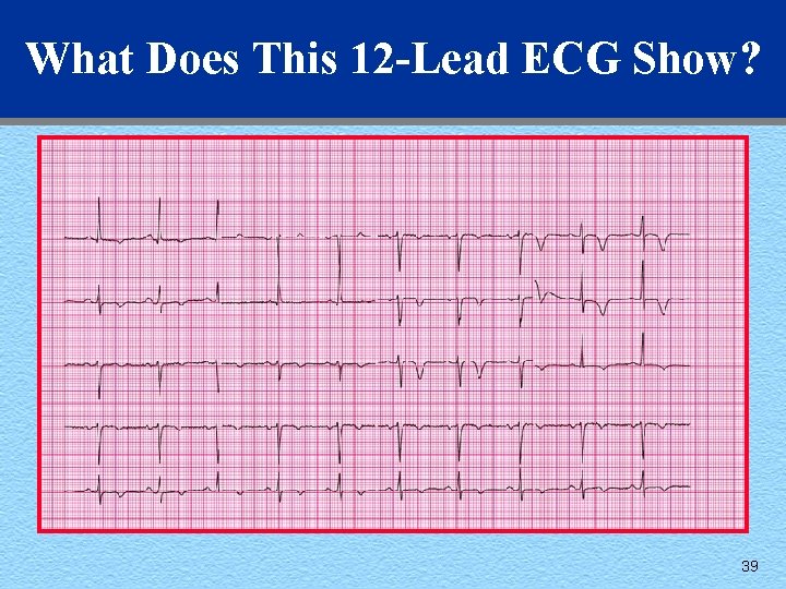 What Does This 12 -Lead ECG Show? 39 