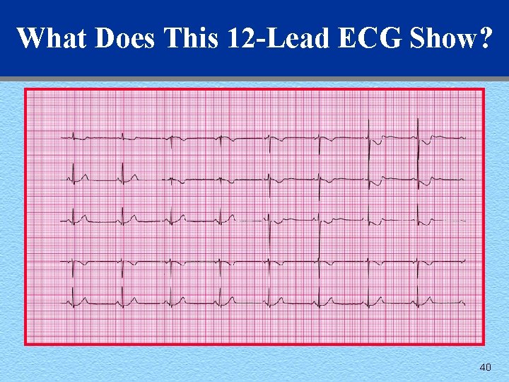What Does This 12 -Lead ECG Show? 40 