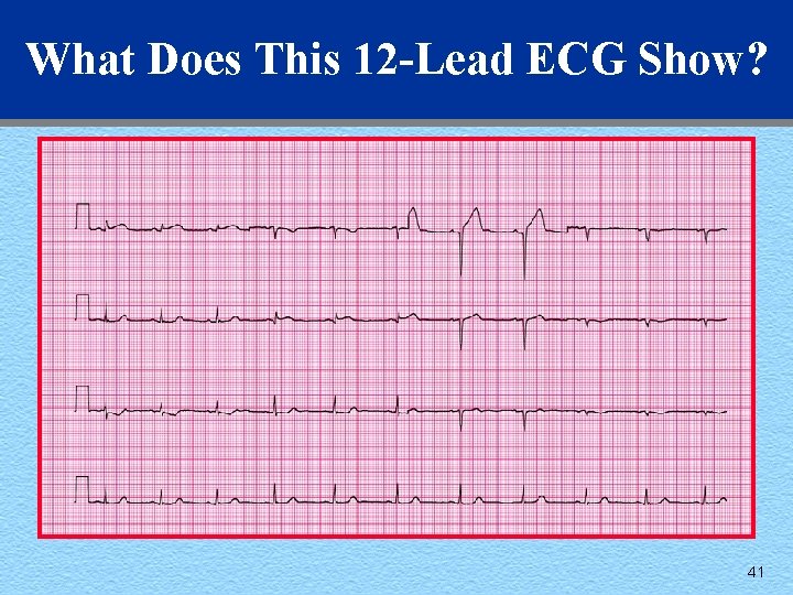 What Does This 12 -Lead ECG Show? 41 