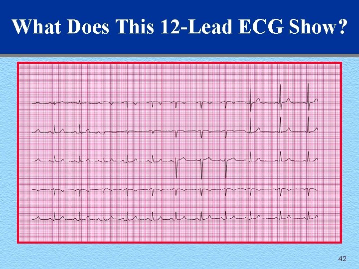 What Does This 12 -Lead ECG Show? 42 
