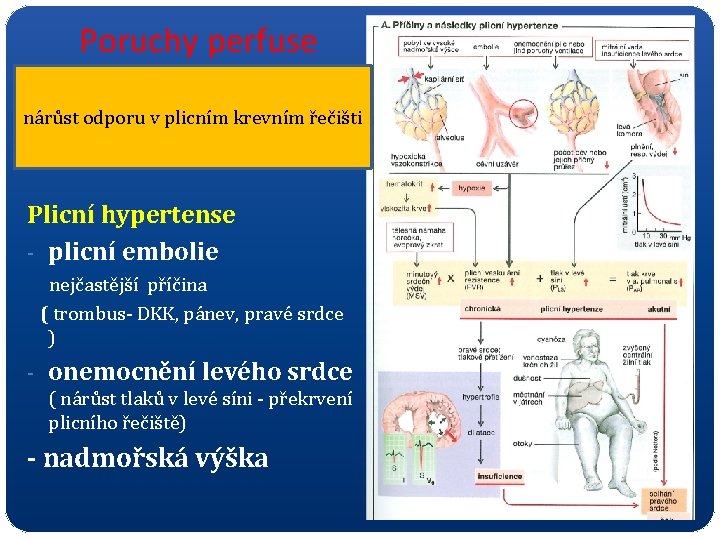 Poruchy perfuse nárůst odporu v plicním krevním řečišti Plicní hypertense - plicní embolie nejčastější