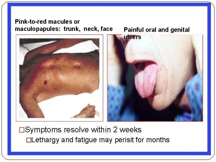 Pink-to-red macules or maculopapules: trunk, neck, face Painful oral and genital ulcers �Symptoms resolve