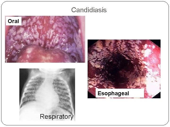 Candidiasis Oral Esophageal Respiratory 