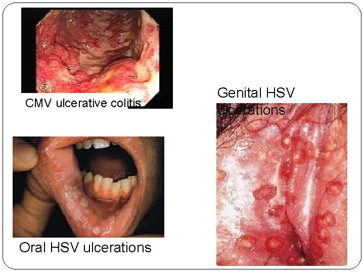 CMV ulcerative colitis Oral HSV ulcerations Genital HSV ulcerations 
