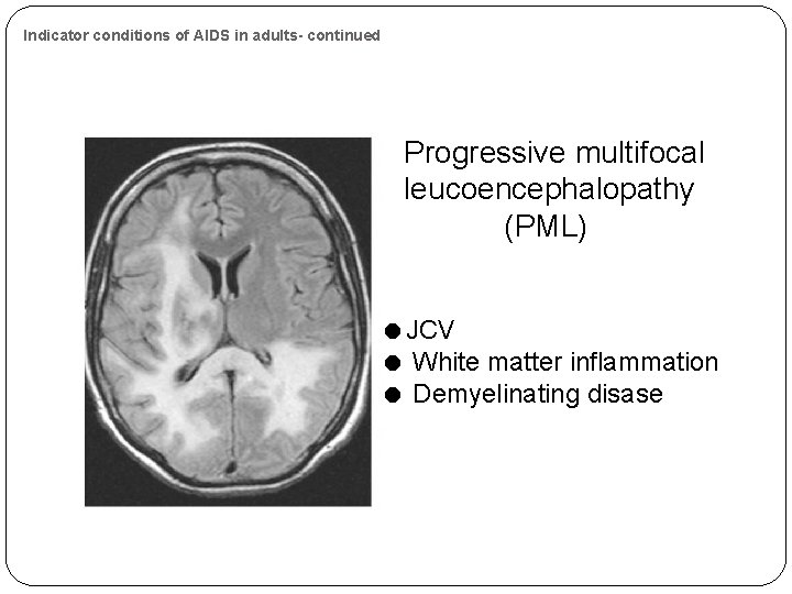 Indicator conditions of AIDS in adults- continued Progressive multifocal leucoencephalopathy (PML) JCV White matter