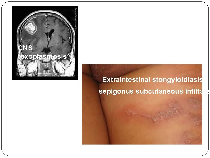 CNS toxoplasmosis Extraintestinal stongyloidiasis sepigonus subcutaneous infiltates 