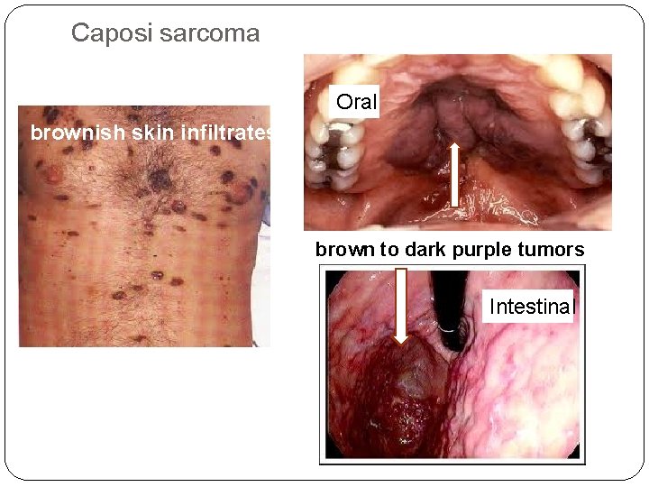 Caposi sarcoma Oral brownish skin infiltrates brown to dark purple tumors Intestinal 