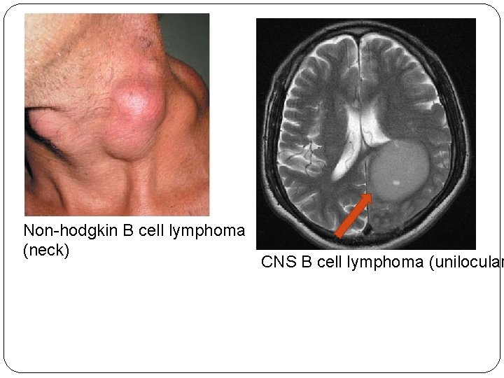 Non-hodgkin B cell lymphoma (neck) CNS B cell lymphoma (unilocular 