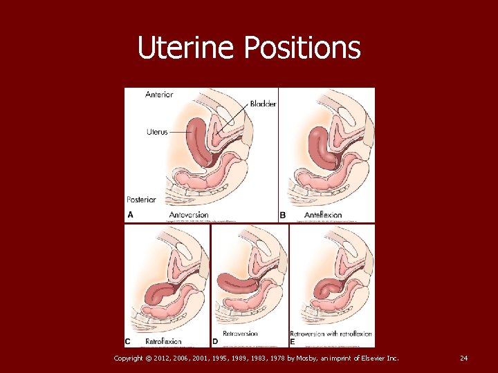 Uterine Positions Copyright © 2012, 2006, 2001, 1995, 1989, 1983, 1978 by Mosby, an