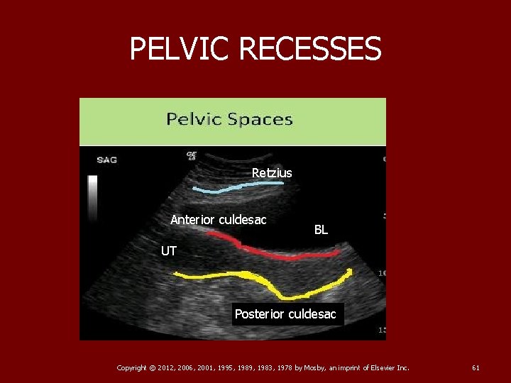 PELVIC RECESSES Retzius Anterior culdesac BL UT Posterior culdesac Copyright © 2012, 2006, 2001,