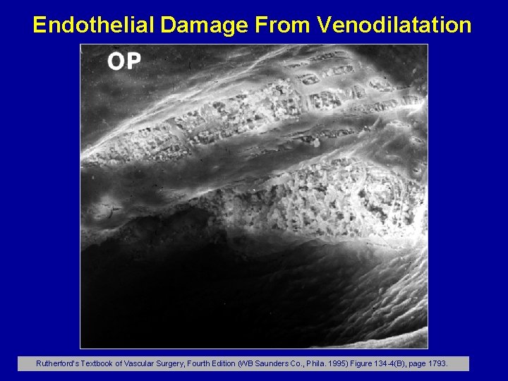 Endothelial Damage From Venodilatation Rutherford’s Textbook of Vascular Surgery, Fourth Edition (WB Saunders Co.