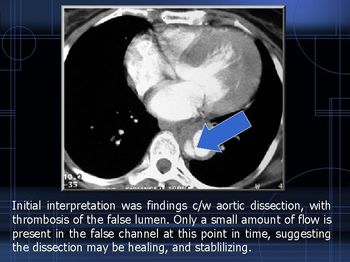 Initial interpretation was findings c/w aortic dissection, with thrombosis of the false lumen. Only