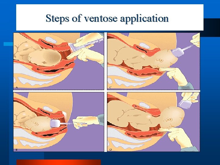 Steps of ventose application 