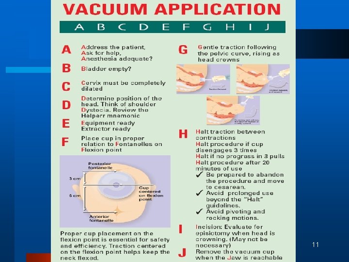Ventose and Forceps delivery Vacuum ventouse Indications MATERNAL