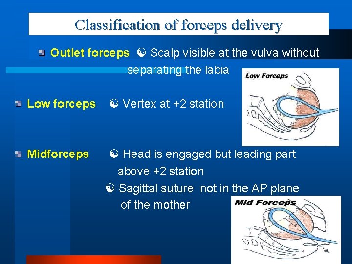 Classification of forceps delivery Outlet forceps Scalp visible at the vulva without separating the