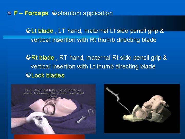 F – Forceps phantom application Lt blade , LT hand, maternal Lt side pencil