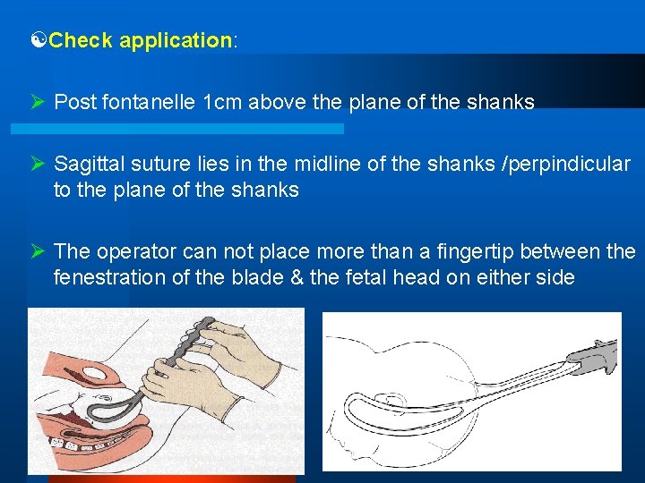  Check application: Ø Post fontanelle 1 cm above the plane of the shanks