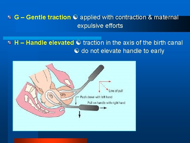 G – Gentle traction applied with contraction & maternal expulsive efforts H – Handle