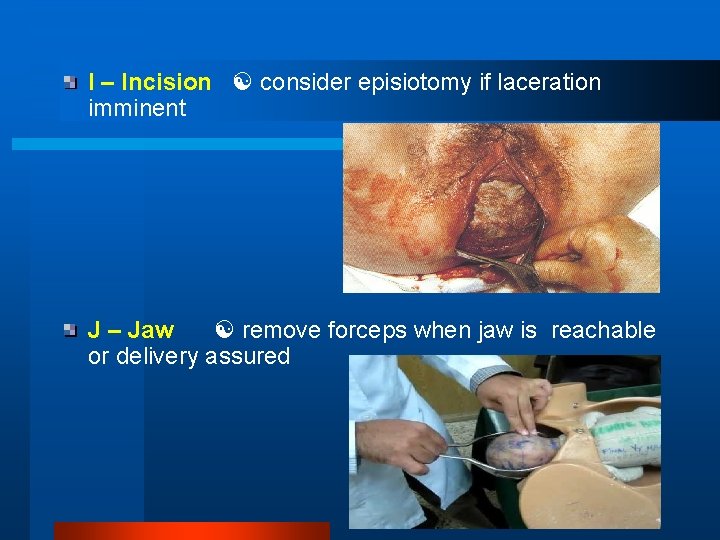 I – Incision consider episiotomy if laceration imminent J – Jaw remove forceps when