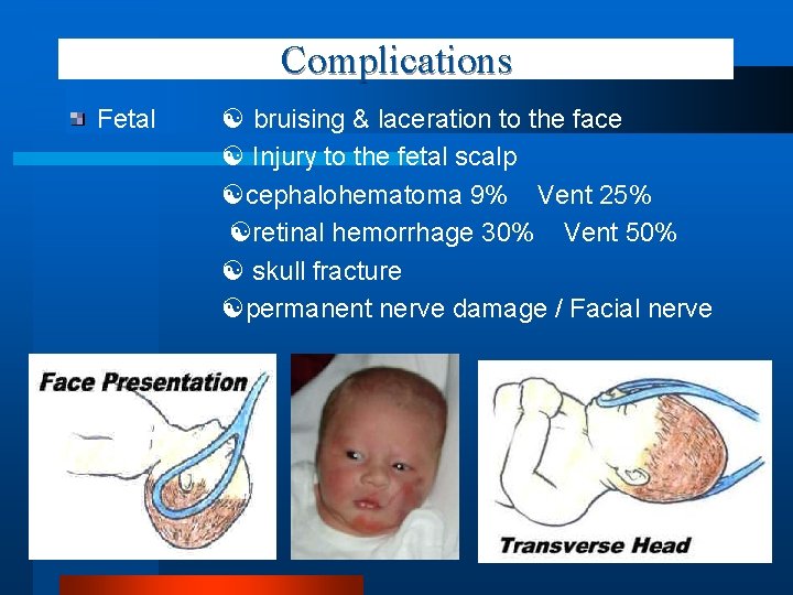 Complications Fetal bruising & laceration to the face Injury to the fetal scalp cephalohematoma