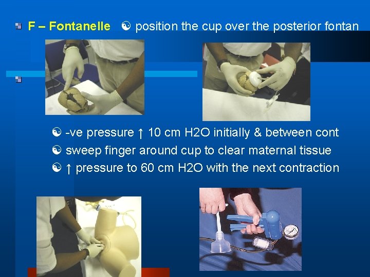 F – Fontanelle position the cup over the posterior fontan -ve pressure ↑ 10