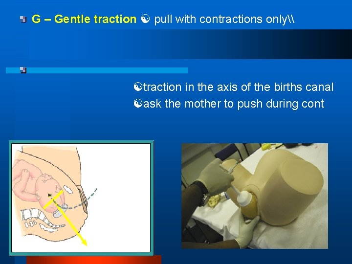 G – Gentle traction pull with contractions only\ traction in the axis of the