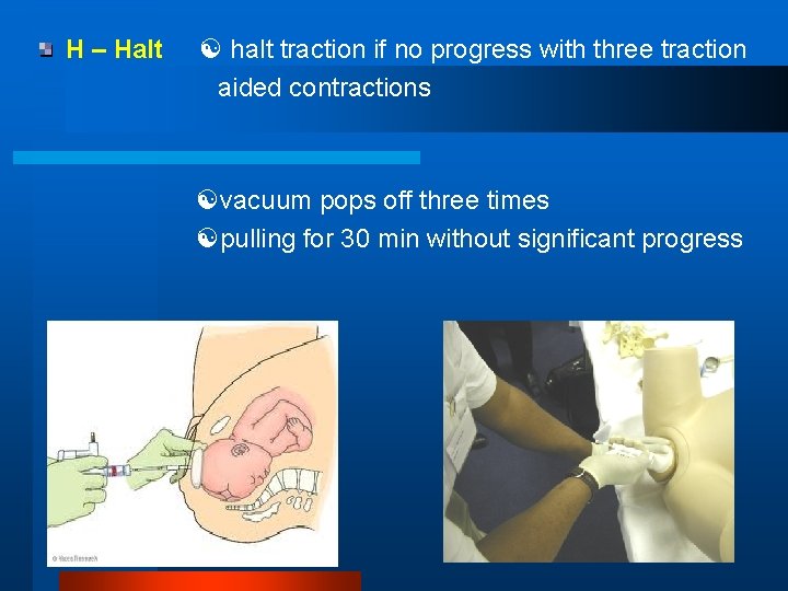 H – Halt halt traction if no progress with three traction aided contractions vacuum