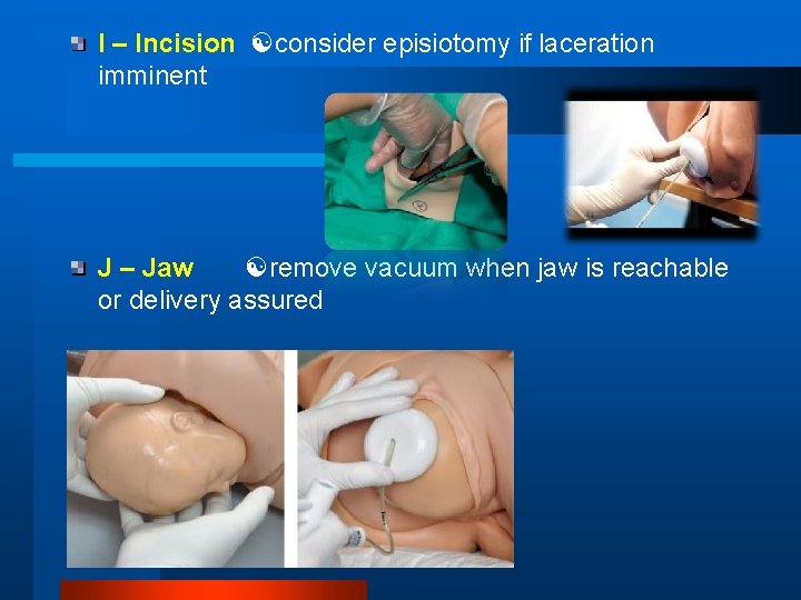 I – Incision consider episiotomy if laceration imminent J – Jaw remove vacuum when