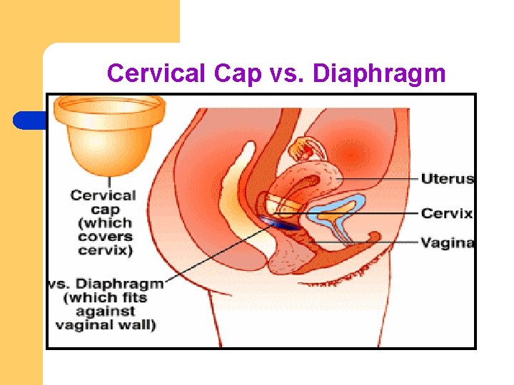 Cervical Cap vs. Diaphragm 