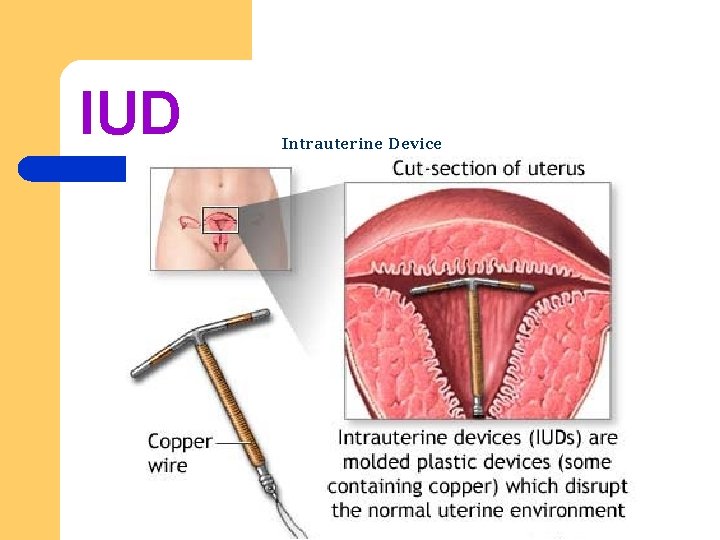 IUD Intrauterine Device 