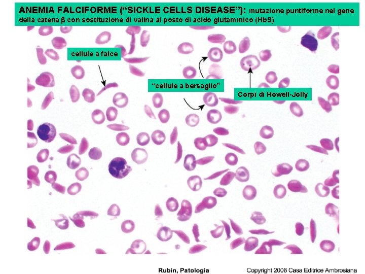 ANEMIA FALCIFORME (“SICKLE CELLS DISEASE”): mutazione puntiforme nel gene della catena b con sostituzione