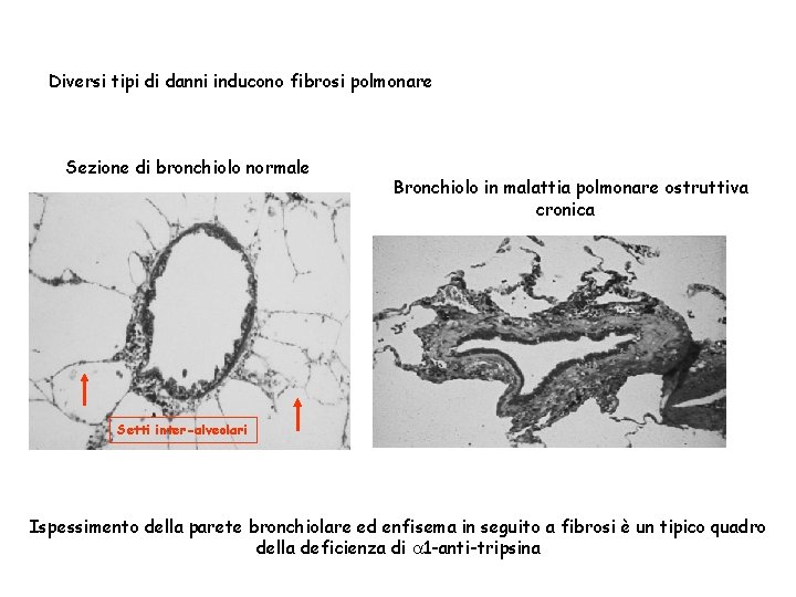 Diversi tipi di danni inducono fibrosi polmonare Sezione di bronchiolo normale Bronchiolo in malattia