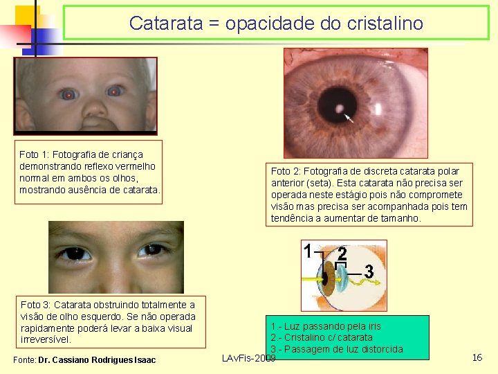 Catarata = opacidade do cristalino Foto 1: Fotografia de criança demonstrando reflexo vermelho normal