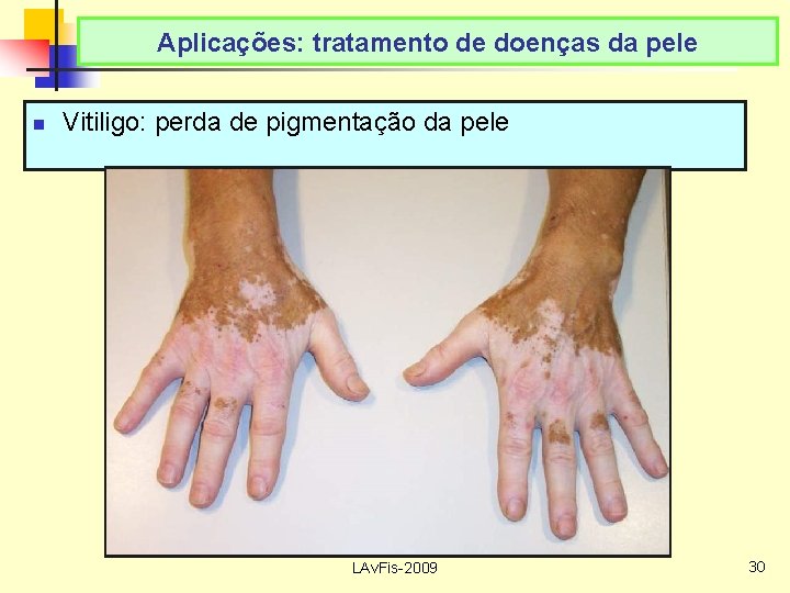 Aplicações: tratamento de doenças da pele n Vitiligo: perda de pigmentação da pele LAv.