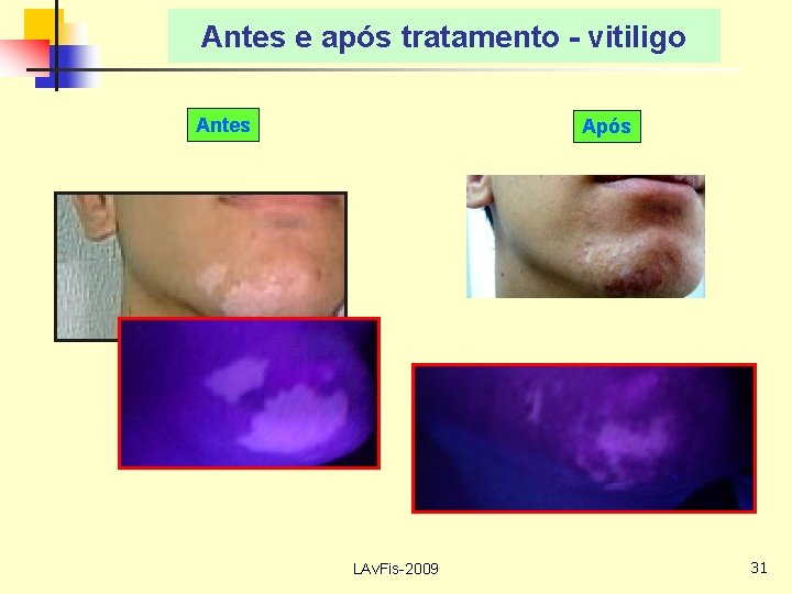 Antes e após tratamento - vitiligo Antes Após LAv. Fis-2009 31 