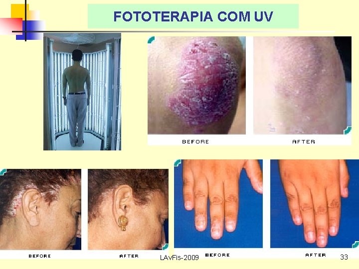 FOTOTERAPIA COM UV LAv. Fis-2009 33 