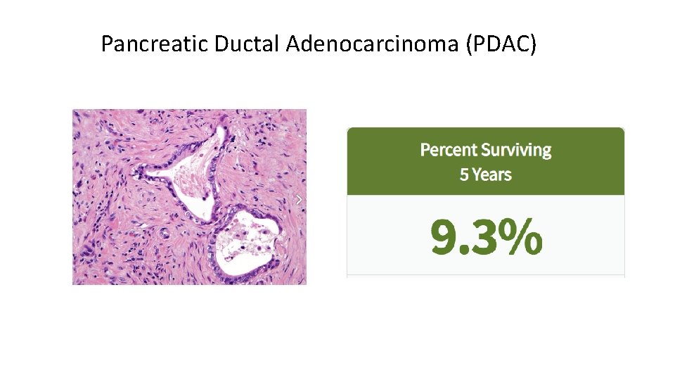 Pancreatic Ductal Adenocarcinoma (PDAC) 
