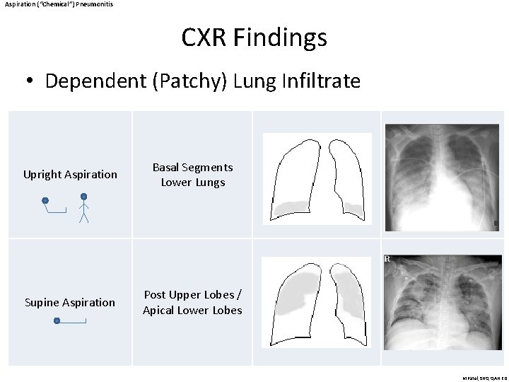 Aspiration (“Chemical”) Pneumonitis CXR Findings • Dependent (Patchy) Lung Infiltrate Upright Aspiration Basal Segments