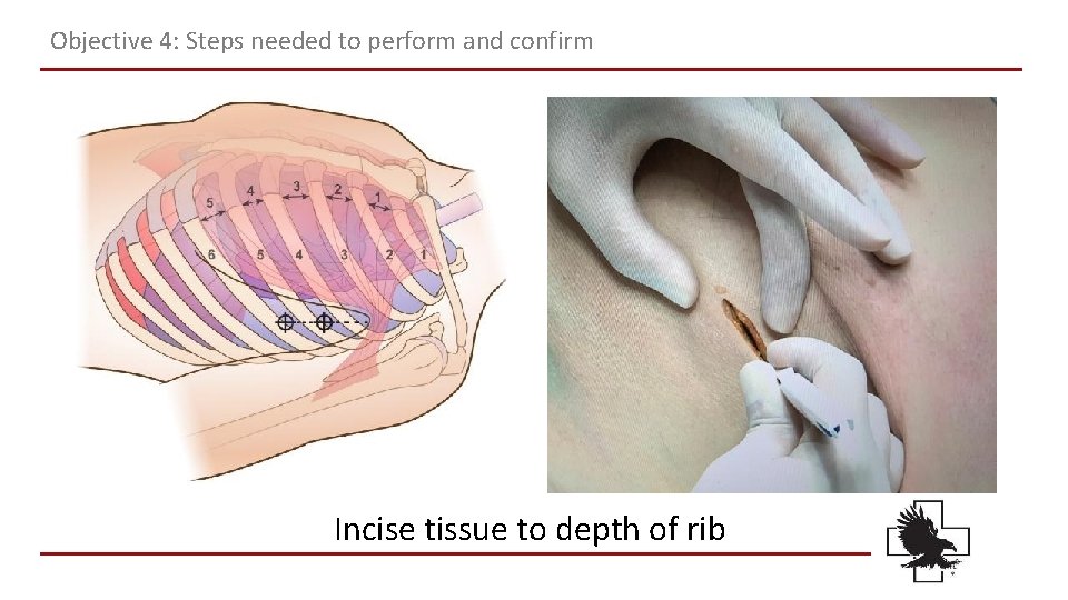 Objective 4: Steps needed to perform and confirm Incise tissue to depth of rib Objective 4: Steps needed to perform and confirm Incise tissue to depth of rib