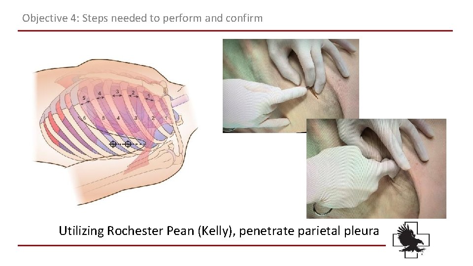Objective 4: Steps needed to perform and confirm Utilizing Rochester Pean (Kelly), penetrate parietal Objective 4: Steps needed to perform and confirm Utilizing Rochester Pean (Kelly), penetrate parietal
