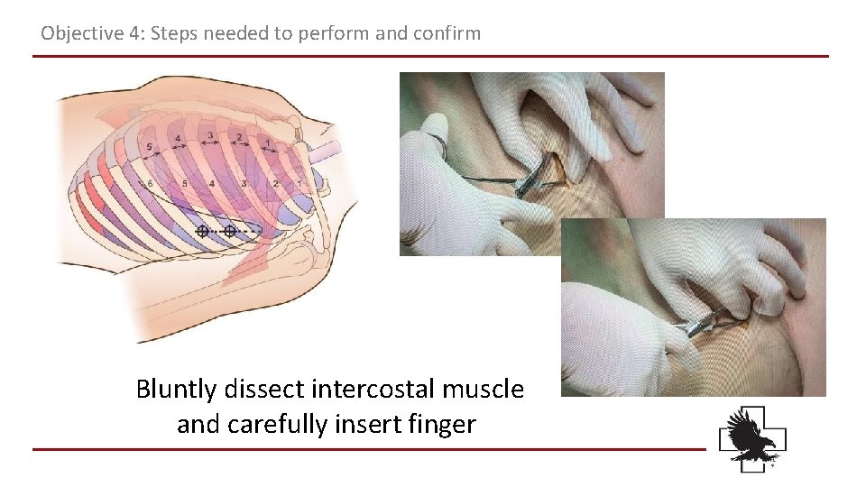 Objective 4: Steps needed to perform and confirm Bluntly dissect intercostal muscle and carefully Objective 4: Steps needed to perform and confirm Bluntly dissect intercostal muscle and carefully