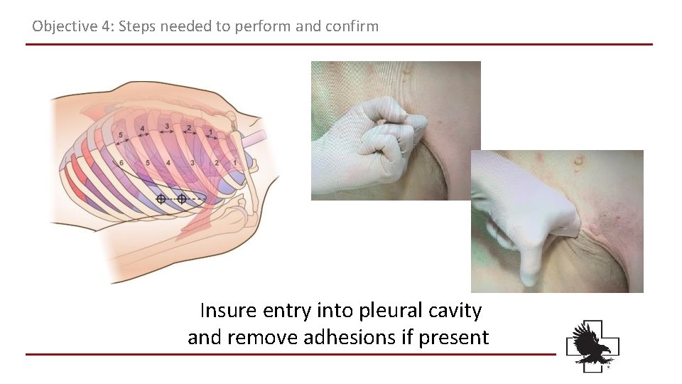 Objective 4: Steps needed to perform and confirm Insure entry into pleural cavity and Objective 4: Steps needed to perform and confirm Insure entry into pleural cavity and