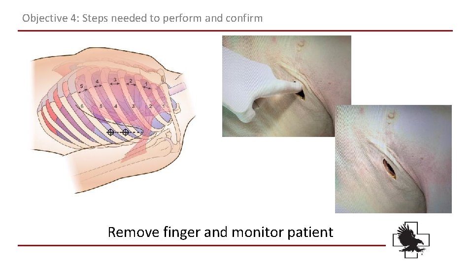 Objective 4: Steps needed to perform and confirm Remove finger and monitor patient Objective 4: Steps needed to perform and confirm Remove finger and monitor patient