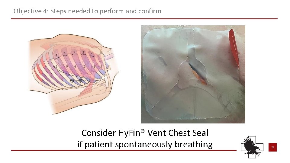 Objective 4: Steps needed to perform and confirm Consider Hy. Fin® Vent Chest Seal Objective 4: Steps needed to perform and confirm Consider Hy. Fin® Vent Chest Seal