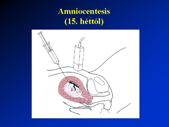 Amniocentesis (15. héttől) 