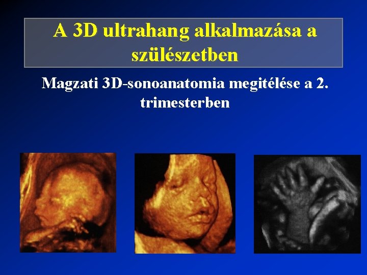 A 3 D ultrahang alkalmazása a szülészetben Magzati 3 D-sonoanatomia megitélése a 2. trimesterben